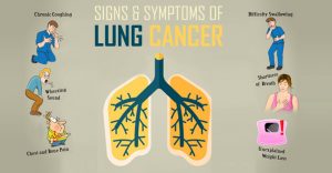 triệu chứng ung thư phổi Điều trị ung thư phổi không phải tế bào nhỏ