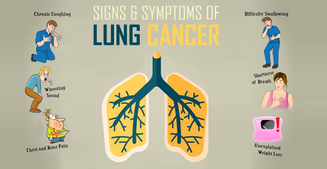 triệu chứng ung thư phổi Điều trị ung thư phổi tất cả những điều cần biết