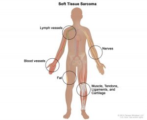 sarcoma mo mem Sarcoma mô mềm là gì và các phương pháp điều trị như thế nào?